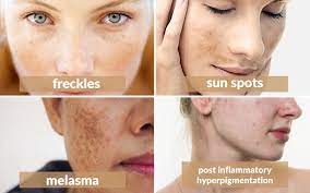WHAT IS PIGMENTATION? MAIN CAUSES OF IT,TYPES OF FACE PIGMENTATION, CAN IT BE REMOVED? WHICH FACIAL IS BEST FOR IT? DIET FOR IT, TAN /BROWN PIGMENTATIOM. DIAGNOSIS, TREATMENT