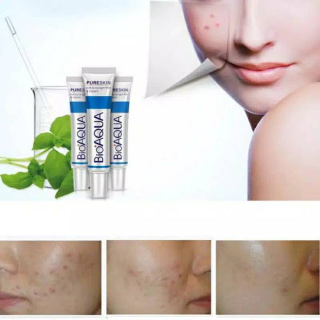 Efek Samping Bioaqua Acne Cream