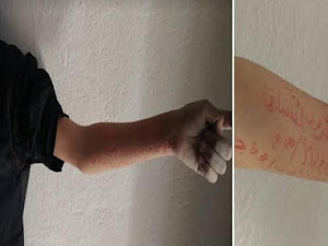 بالصور : سيدي بوزيد معلمة تعاقب تلميذها بوضع علامة قاطع ومقطوع على وجهه وكتابة تمرين على يده!