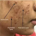 How to remove acne scars/acne scar cream/acne scar laser/how acne scar comes on face/