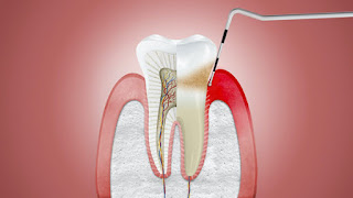 Tham khảo nhổ răng đã lấy tủy có đau không từ nha sĩ-2