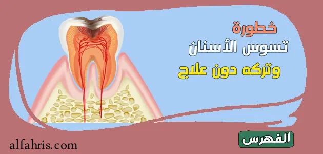 تعرف على خطورة تسوس الأسنان