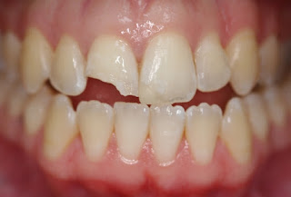 Quy trình thực hiện trám răng thẩm mỹ-1