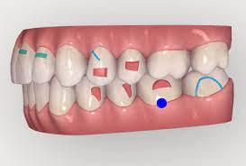 Ataches dientes ortodoncia Invisalign