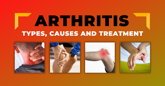 ARTHRITIS - TYPES, CAUSES AND TREATMENT