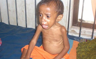marasmik-kwashiorkor