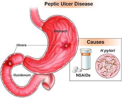 Peptic Ulcer Disease: Causes, Symptoms, Treatment, and Prevention