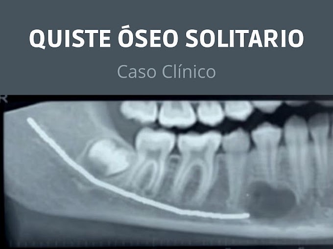 CASO CLÍNICO:  Quiste óseo solitario. Lesión ósea benigna, no neoplásica