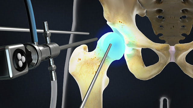 Arthroscopy Devices Market