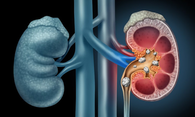 Kidney Stone Laser Treatment Cost in India