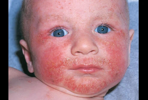 WHAT IS ATOPIC DERMATITIS? MAIN CAUSES, SYMPTOMS,  TYPES OF DERMATITIS, WHAT IS DIFFERENCE BETWEENCAN  ECZMA AND ATOPIC DERMATITIS? CAN ATOPIC DERMATITIS GO AWAY? DIAGNOSIS, TREATMENT