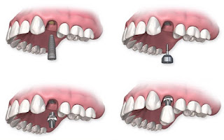 Quy trình cấy ghép răng Implant-2