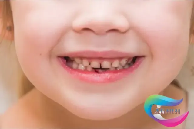 What causes a piece of meat to appear in the gums of children?