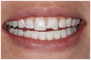 Quy trình trám răng tại nha khoa-1