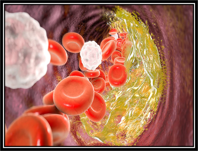 Nutrition therapy for Atherosclerosis