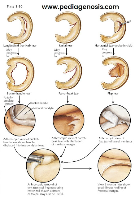 TEARS OF THE MENISCUS