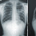 Lung Cancer - Types Of Cancer, Staging & Grading, Treatment Of Lung Cancer