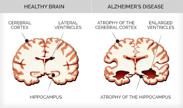 Best practices in your 20’s to avoid Alzheimer’s disease in your 70’s