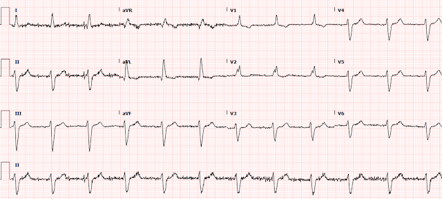 A man in his 60s with syncope. In syncope, what are we looking for on the ECG, and why?