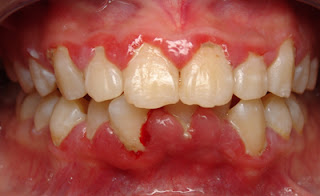 Dấu hiệu nhận biết viêm lợi sau khi bọc răng-2