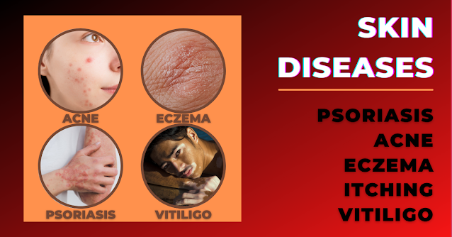 SKIN  DISEASES - ACNE, PSORIASIS, ECZEMA, VITILIGO