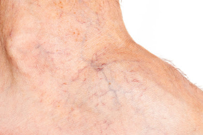 Sclerotherapy — Spider Vein Treatment