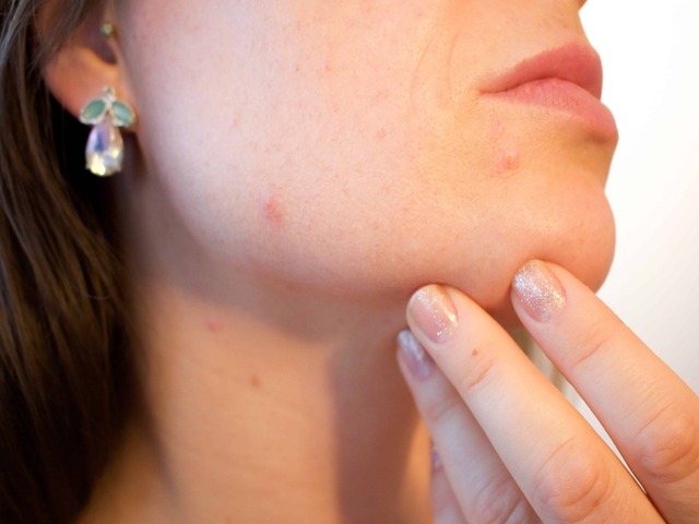 Types of Acne— Causes & Treatment