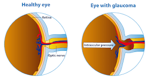 Cannabis for Glaucoma