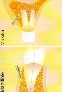 Angle of mini implants or temporary anchorage devices (TADs)