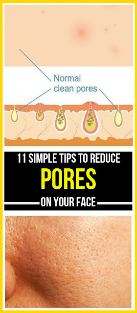 11 Simple Tips To Reduce Pores On Your Face