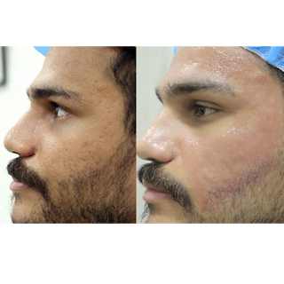 eMatrix Skin Rejuvenation In Bella Roma Hospital Dubai  |   إيماتركس بيلا روما