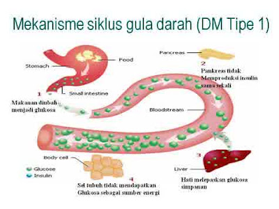 penyebab diabetes melitus tipe 1