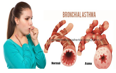 Penyebab Dan Gejala Penyakit Asma Bronkial