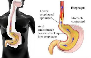 acid reflux, heart burn, remedy