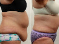  Get Rid Of Belly Fat Quickly