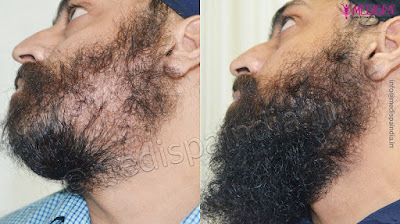 Beard Hair Transplant