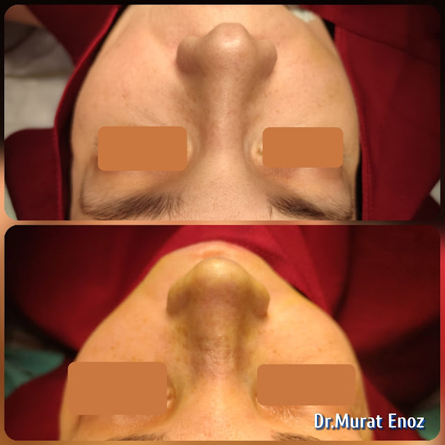 Micromotor Assisted Natural Rhinoplasty,Natural nose job for women, Simple rhinoplasty, Personal nose cosmetic procedure