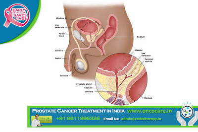 top Prostate cancer treatment in india