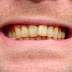 Làm trắng răng nhiễm màu kháng sinh bằng cách nào?