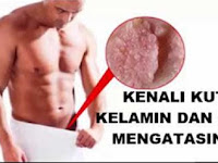 Obat Kutil Kelamin Oles