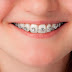 Yếu tố ảnh hưởng đến quá trình niềng răng thưa