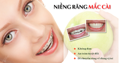 Niềng răng gắn mắc cài có ưu điểm gì ?