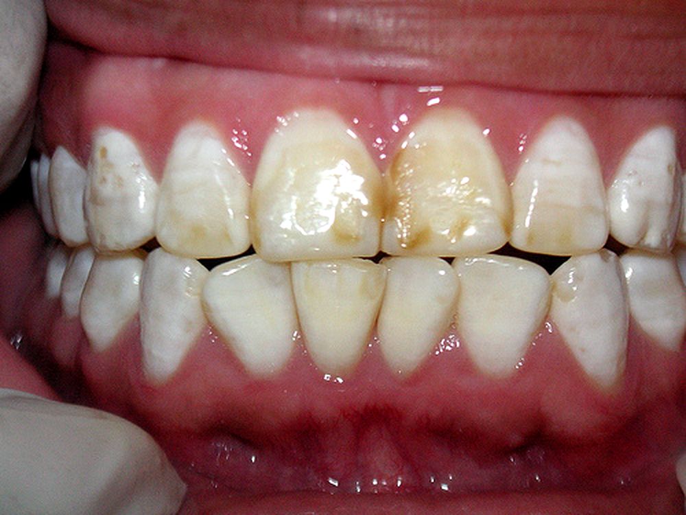 Fluorosis Dental