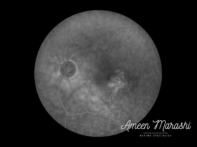Mid phase FFA showing increased hyperfluorescence of the notch