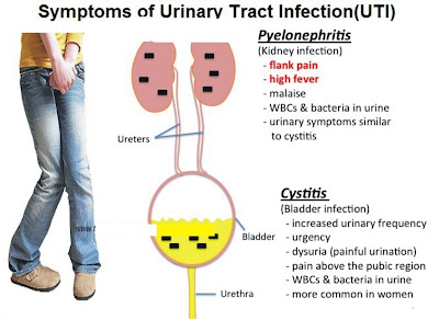 Symptoms of Urinary Tract Infection (UTI) 