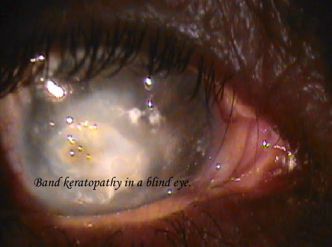 Penetrating Eye Injury. Penetrating Eye Injury,