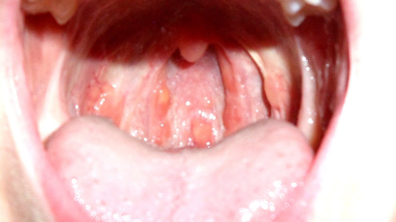 Sore Throat With Yellow Mucus