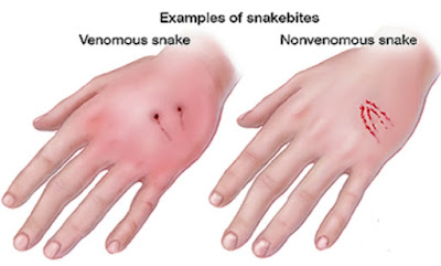 No matter how many poisonous snakes bite you, do this and save your life!