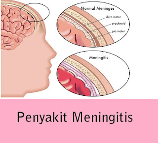 Info penyakit Meningitis