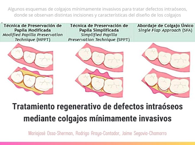 PDF: Tratamiento regenerativo de defectos intraóseos mediante colgajos mínimamente invasivos: Revisión sistemática exploratoria